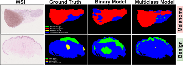 Figure 3 for Detection and Localization of Melanoma Skin Cancer in Histopathological Whole Slide Images