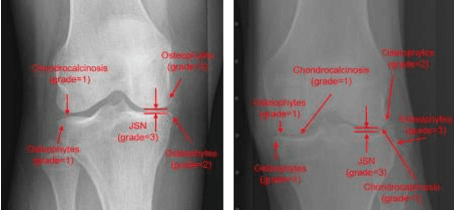 Figure 1 for Application Of Vision-Language Models For Assessing Osteoarthritis Disease Severity