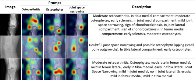Figure 3 for Application Of Vision-Language Models For Assessing Osteoarthritis Disease Severity