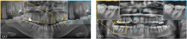 Figure 1 for Adapting Foundation Model for Dental Caries Detection with Dual-View Co-Training