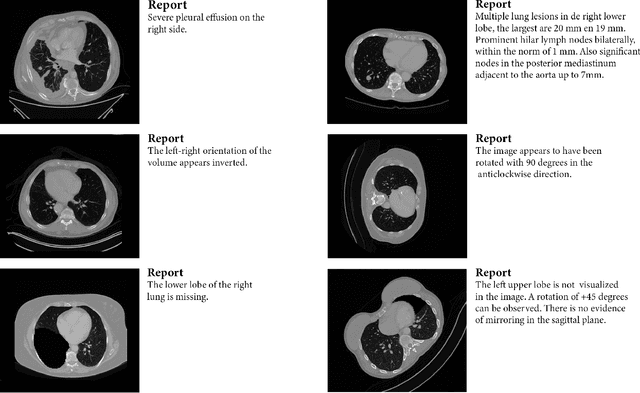 Figure 3 for Automatically Generating Narrative-Style Radiology Reports from Volumetric CT Images; a Proof of Concept