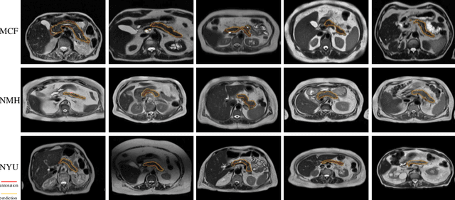 Figure 3 for Radiomics Boosts Deep Learning Model for IPMN Classification