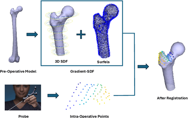 Figure 2 for Partial-to-Full Registration based on Gradient-SDF for Computer-Assisted Orthopedic Surgery
