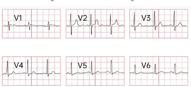 Figure 4 for Design of a Noval Wearable ECG Monitoring Device