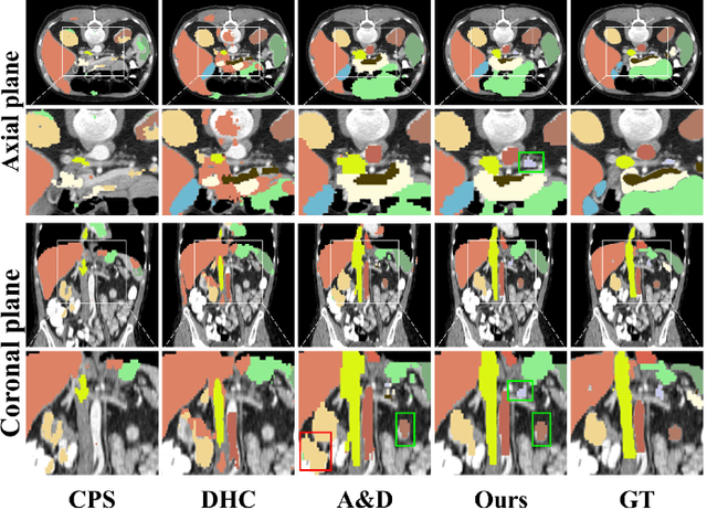 Figure 3 for Boosting Generic Semi-Supervised Medical Image Segmentation via Diverse Teaching and Label Propagation