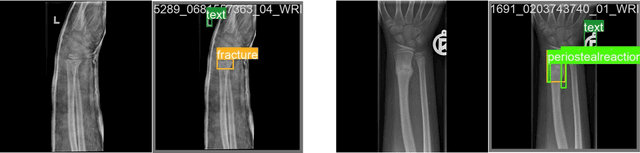 Figure 1 for YOLOv8-AM: YOLOv8 with Attention Mechanisms for Pediatric Wrist Fracture Detection