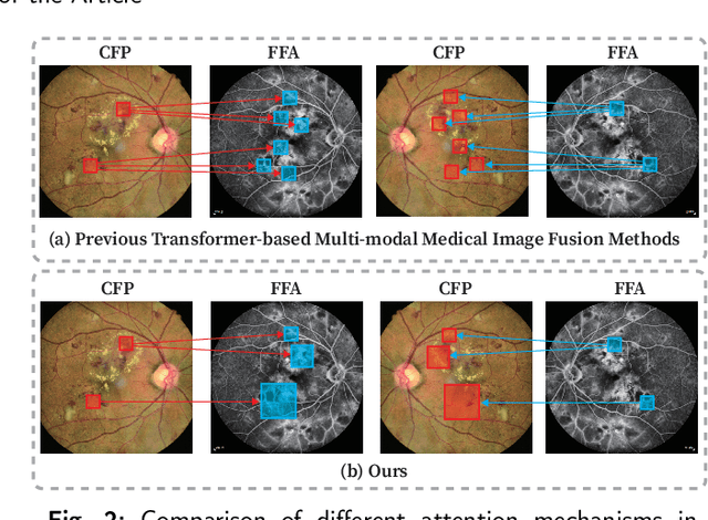 Figure 3 for Multi-modal and Multi-view Fundus Image Fusion for Retinopathy Diagnosis via Multi-scale Cross-attention and Shifted Window Self-attention