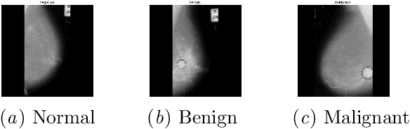 Figure 3 for Interpretable breast cancer classification using CNNs on mammographic images