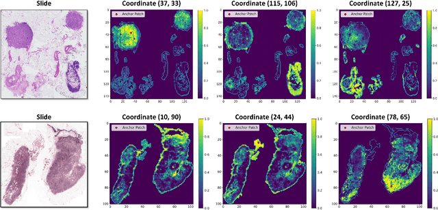 Figure 4 for MambaMIL+: Modeling Long-Term Contextual Patterns for Gigapixel Whole Slide Image