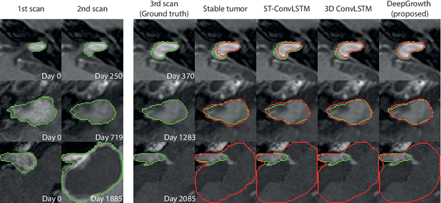 Figure 4 for Vestibular schwannoma growth prediction from longitudinal MRI by time conditioned neural fields