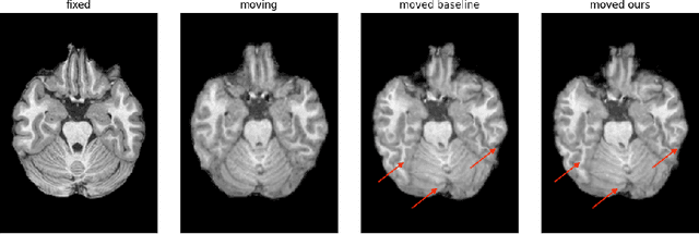 Figure 2 for Fine-Tuning TransMorph with Gradient Correlation for Anatomical Alignment