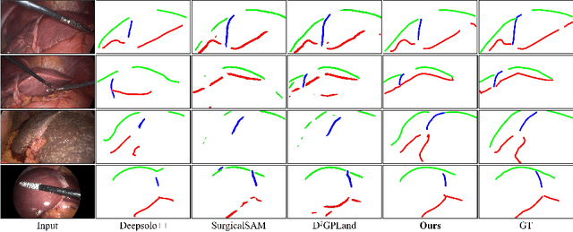 Figure 3 for BCRNet: Enhancing Landmark Detection in Laparoscopic Liver Surgery via Bezier Curve Refinement