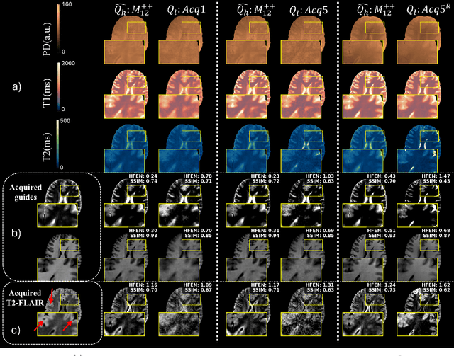 Figure 4 for Self-Supervised Weighted Image Guided Quantitative MRI Super-Resolution