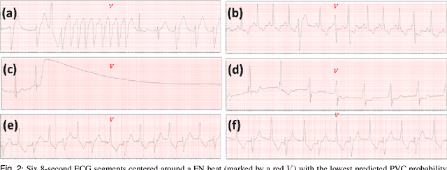 Figure 2 for uPVC-Net: A Universal Premature Ventricular Contraction Detection Deep Learning Algorithm