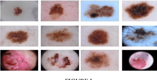 Figure 1 for Eliminating Mole Size in Melanoma Classification