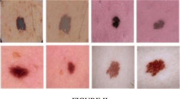 Figure 3 for Eliminating Mole Size in Melanoma Classification