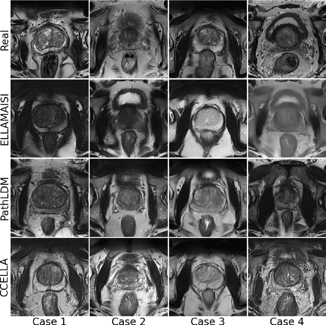 Figure 4 for Prompt-Guided Latent Diffusion with Predictive Class Conditioning for 3D Prostate MRI Generation