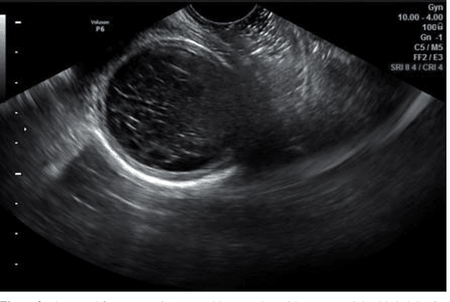 Figure 3 for Comparing the physical characteristics of ultrasound and magnetic resonance imaging to diagnose ovarian cysts