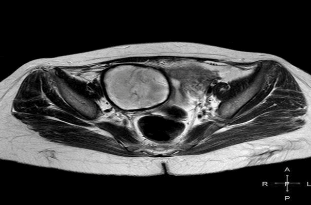 Figure 4 for Comparing the physical characteristics of ultrasound and magnetic resonance imaging to diagnose ovarian cysts