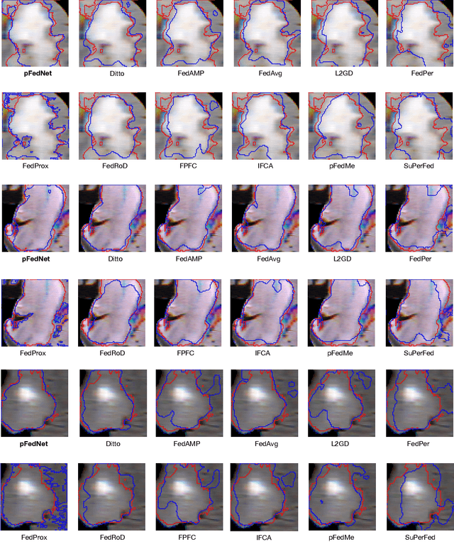 Figure 3 for Medical Federated Model with Mixture of Personalized and Sharing Components