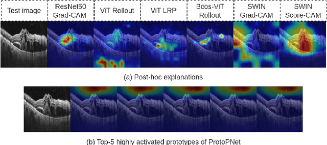 Figure 1 for PiPViT: Patch-based Visual Interpretable Prototypes for Retinal Image Analysis