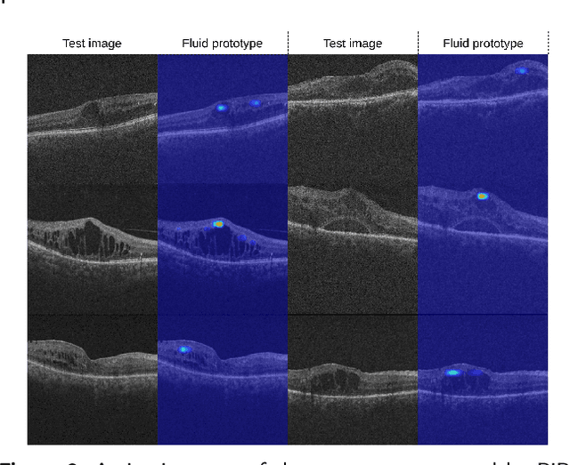 Figure 3 for PiPViT: Patch-based Visual Interpretable Prototypes for Retinal Image Analysis