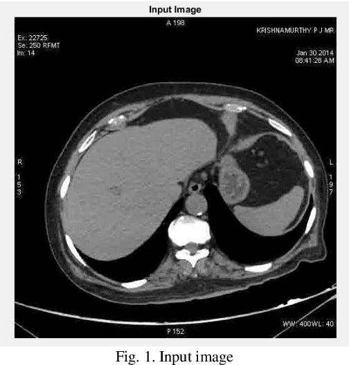 Figure 1 for Lung Cancer Detection from CT Scan Images based on Genetic-Independent Recurrent Deep Learning