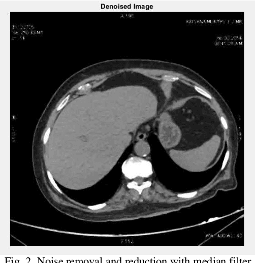 Figure 4 for Lung Cancer Detection from CT Scan Images based on Genetic-Independent Recurrent Deep Learning