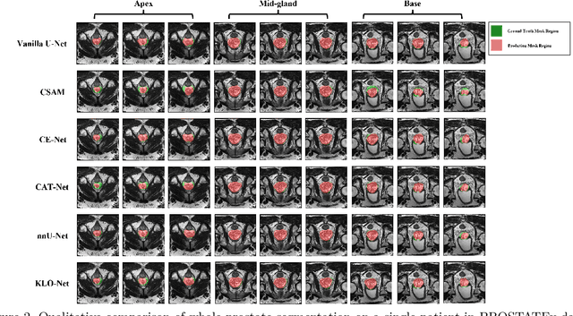 Figure 3 for KLO-Net: A Dynamic K-NN Attention U-Net with CSP Encoder for Efficient Prostate Gland Segmentation from MRI