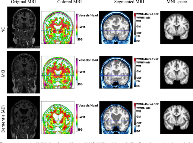 Figure 1 for Leveraging Video Vision Transformer for Alzheimer's Disease Diagnosis from 3D Brain MRI