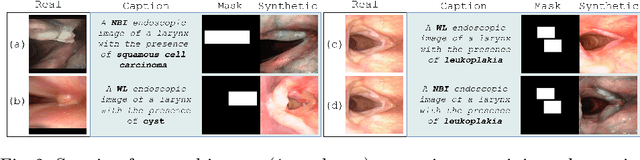 Figure 3 for Clinically-guided Data Synthesis for Laryngeal Lesion Detection