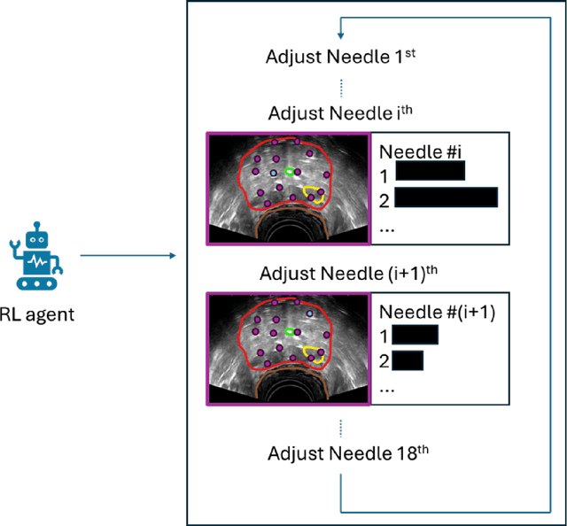 Figure 1 for Automatic Treatment Planning using Reinforcement Learning for High-dose-rate Prostate Brachytherapy