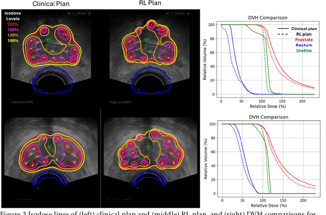 Figure 3 for Automatic Treatment Planning using Reinforcement Learning for High-dose-rate Prostate Brachytherapy