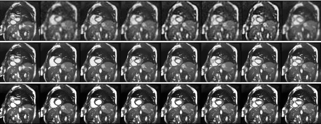 Figure 4 for Temporal and Spatial Super Resolution with Latent Diffusion Model in Medical MRI images
