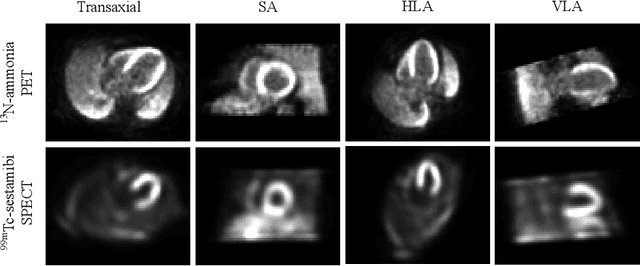 Figure 1 for A Multi-Scale Spatial Transformer U-Net for Simultaneously Automatic Reorientation and Segmentation of 3D Nuclear Cardiac Images