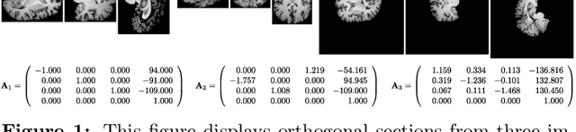 Figure 1 for PatchMorph: A Stochastic Deep Learning Approach for Unsupervised 3D Brain Image Registration with Small Patches
