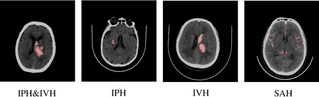 Figure 1 for An Automatic Cascaded Model for Hemorrhagic Stroke Segmentation and Hemorrhagic Volume Estimation