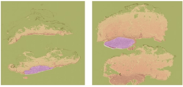 Figure 3 for Deep Learning for Predicting Metastasis on Melanoma WSIs