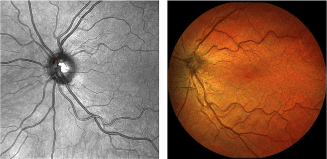 Figure 1 for A publicly available vessel segmentation algorithm for SLO images