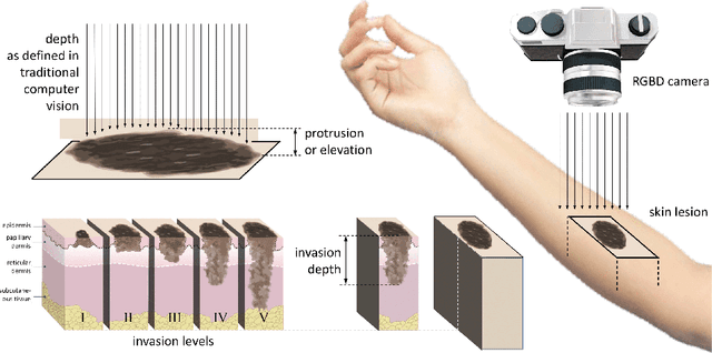 Figure 1 for Lesion Elevation Prediction from Skin Images Improves Diagnosis