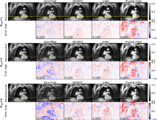 Figure 3 for Accelerated respiratory-resolved 4D-MRI with separable spatio-temporal neural networks