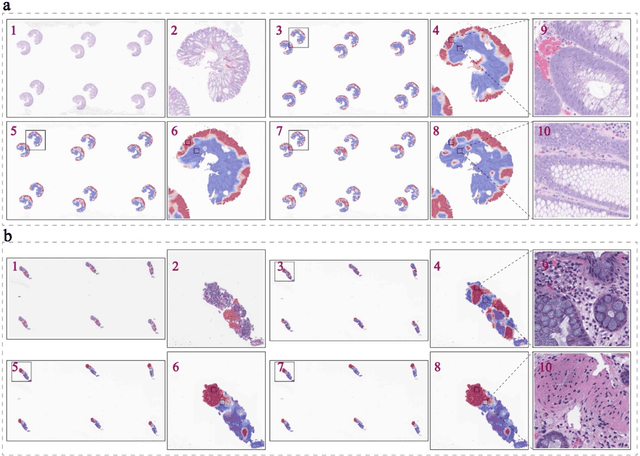 Figure 3 for Improving Colorectal Cancer Screening and Risk Assessment through Predictive Modeling on Medical Images and Records