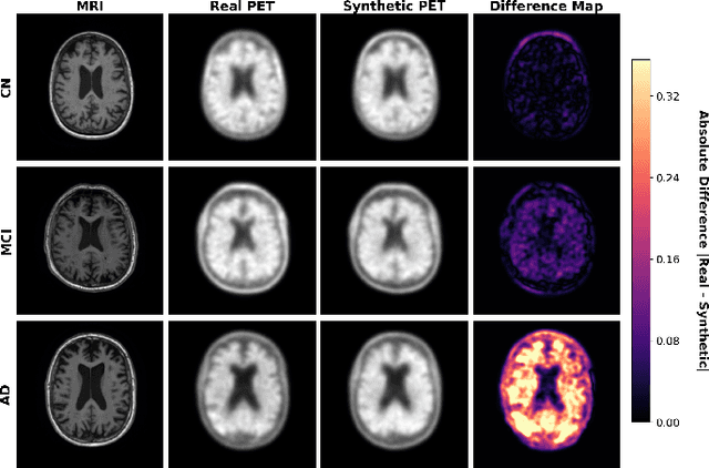 Figure 4 for MCR-VQGAN: A Scalable and Cost-Effective Tau PET Synthesis Approach for Alzheimer's Disease Imaging