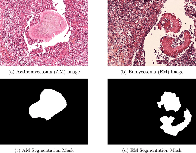 Figure 2 for AI for Mycetoma Diagnosis in Histopathological Images: The MICCAI 2024 Challenge