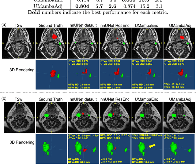 Figure 4 for UMambaAdj: Advancing GTV Segmentation for Head and Neck Cancer in MRI-Guided RT with UMamba and nnU-Net ResEnc Planner