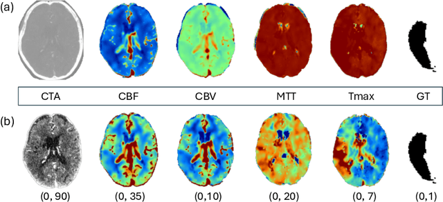 Figure 1 for How We Won the ISLES'24 Challenge by Preprocessing