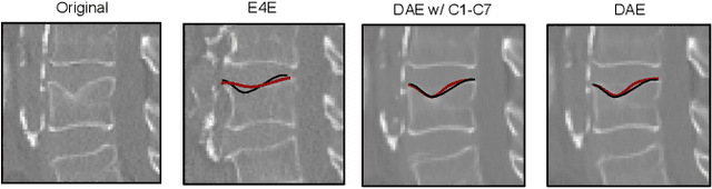 Figure 4 for Semantic Latent Space Regression of Diffusion Autoencoders for Vertebral Fracture Grading