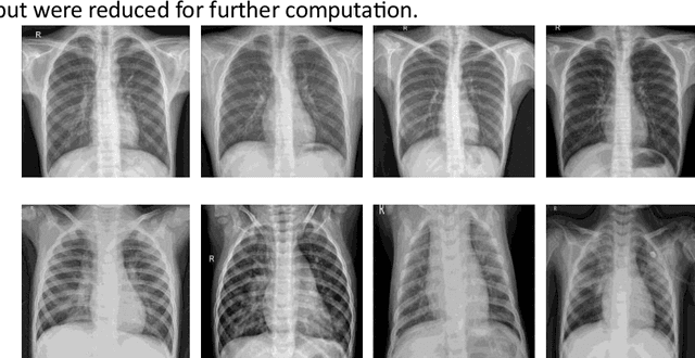Figure 1 for Hybrid Inception Architecture with Residual Connection: Fine-tuned Inception-ResNet Deep Learning Model for Lung Inflammation Diagnosis from Chest Radiographs