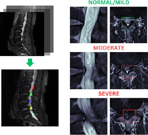 Figure 1 for M-SCAN: A Multistage Framework for Lumbar Spinal Canal Stenosis Grading Using Multi-View Cross Attention