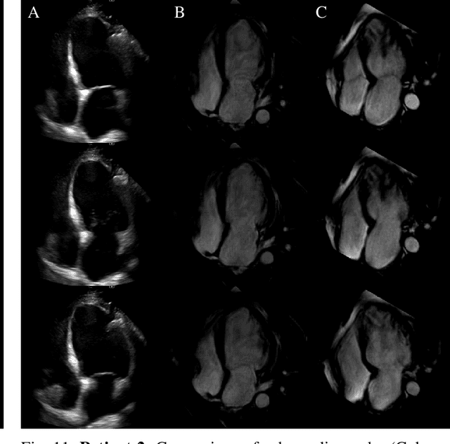 Figure 3 for Echocardiography to Cardiac MRI View Transformation for Real-Time Blind Restoration
